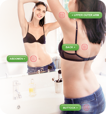Image of woman showing locations where XULANE patch can be placed: Abdomen, Upper outer arm, Back, or Buttock Image of woman showing locations where XULANE patch can be placed: Abdomen, Upper outer arm, Back, or Buttock