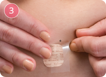Patient applying sticky side of XULANE patch to skin. Patient applying sticky side of XULANE patch to skin.